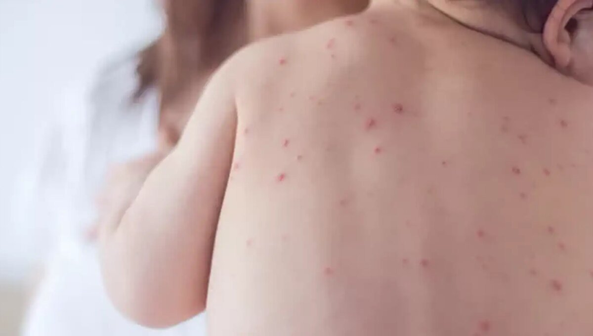 Estado de São Paulo reforça necessidade de vacinação contra o sarampo
