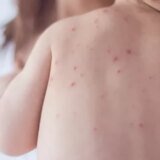 Estado de São Paulo reforça necessidade de vacinação contra o sarampo