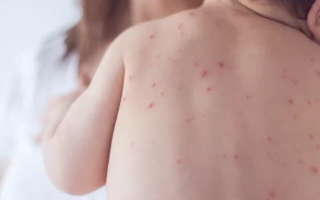 Estado de São Paulo reforça necessidade de vacinação contra o sarampo