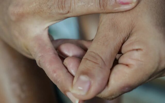 Dermatite atópica impacta pele, sono e autoestima: saiba como tratar