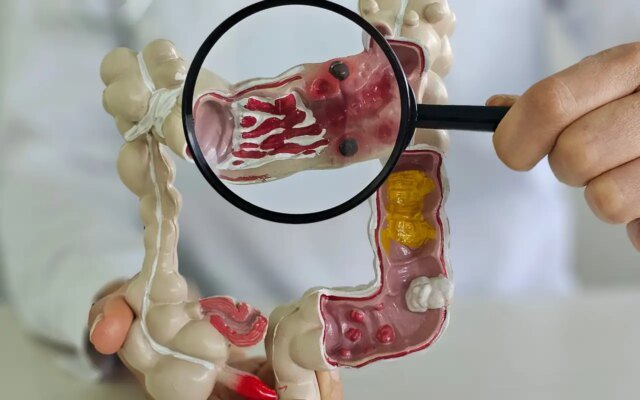 Em 13 anos, doença inflamatória intestinal cresce 5 vezes no Brasil