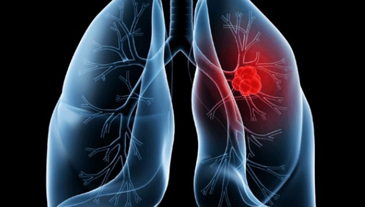Saiba o que é adenocarcinoma pulmonar, câncer que atinge o papa