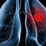 Saiba o que é adenocarcinoma pulmonar, câncer que atinge o papa